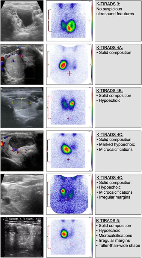 The Journey Of Ultrasound Based Thyroid Nodule Risk Stratification | My XXX Hot Girl