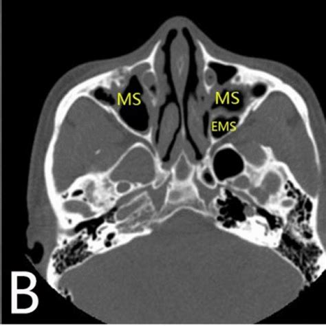 Morphology and anatomy of EMS. Identification of EMS in the a coronal,... | Download Scientific ...