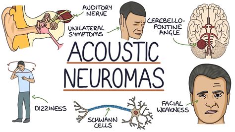 Beautiful Tips About How To Diagnose Acoustic Neuroma - Icecarpet