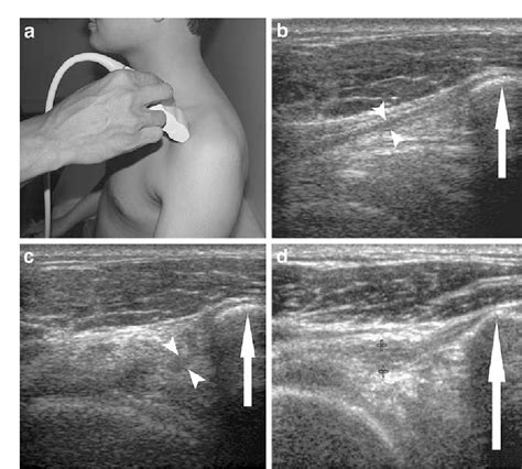 Structure of coracohumeral ligament | Semantic Scholar