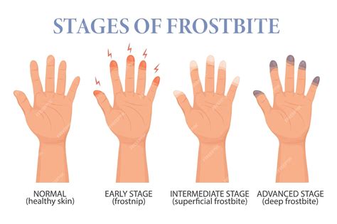 Premium Vector | Frostbite stages. frozen hands in different stages ...