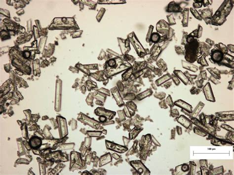 Struvite crystals | Medical Laboratories