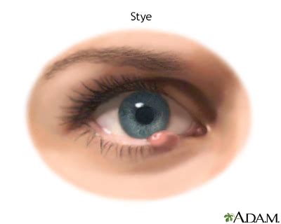 Eyelid bump Information | Mount Sinai - New York