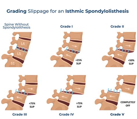 Over 9 Facts You Can Learn About Spondylolisthesis