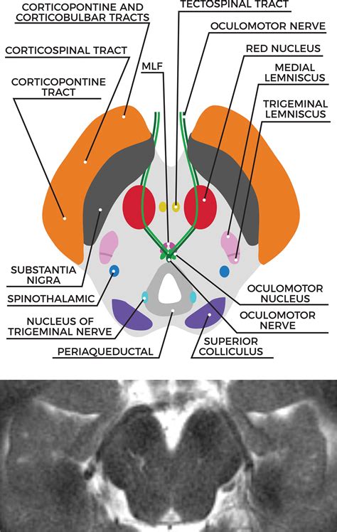 Midbrain, Pons, and Medulla: Anatomy and Syndromes | RadioGraphics