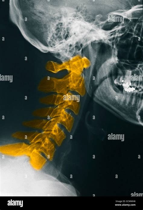 Cervical Spine X Ray Anatomy