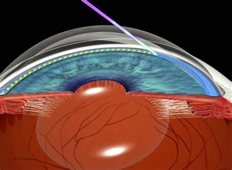 Yag Laser Iridotomy