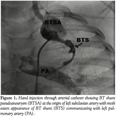 Exclusion of Infected Pseudoaneurysm of Modified Blalock Taussig Shunt ...