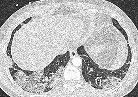 40-year-old non-vaccinated male patient with a typical crazy-paving... | Download Scientific Diagram