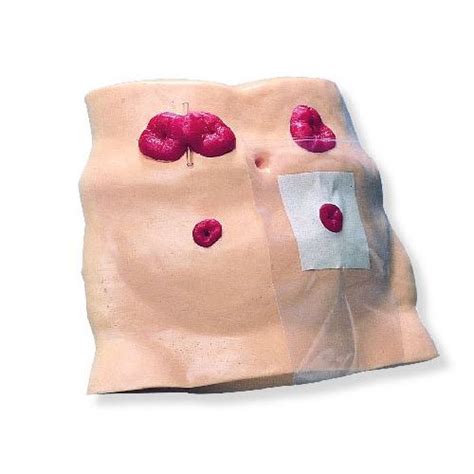 Ostomy Care Model | Health and Care