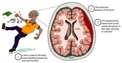 Could a Medication Help With Bleeding Between the Skull and the Brain? · Frontiers for Young Minds