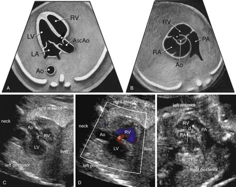 Fetal Lvot Ultrasound