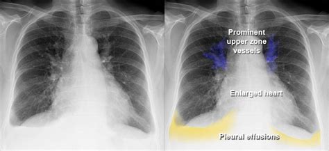 Chest X Ray Pleural Effusion Interpretation