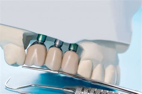 7 Most Important Facts About Dental Implants - Delta Dentistry