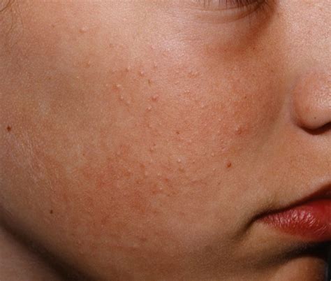 Keratosis Pilaris - Causes, Symptoms, How To Get Rid of It