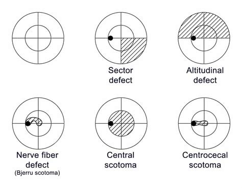 How to Use the Amsler Grid - Towne Lake Eye Associates