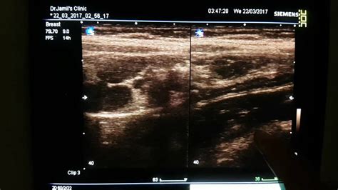 Lymphadenitis Ultrasound - YouTube