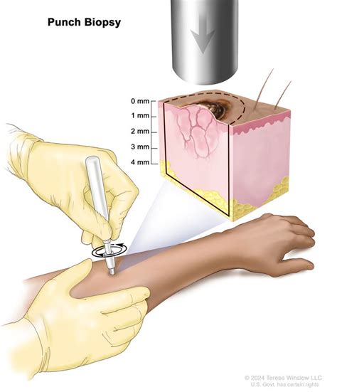 Skin Cancer | Vanderbilt-Ingram Cancer Center