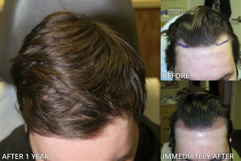 Before and After Picutres | ARTAS - Robotic Hair Transplant