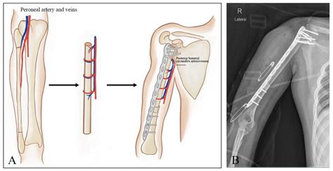 JCM | Free Full-Text | A Retrospective Study of the Functional Outcomes ...