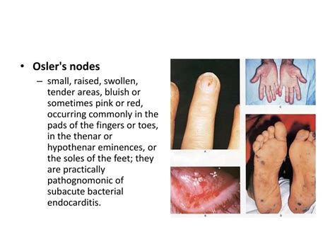 PPT - Osler's nodes PowerPoint Presentation, free download - ID:2131707