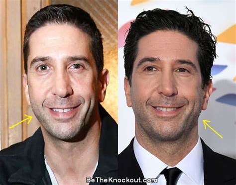 David Schwimmer Plastic Surgery Comparison Photos