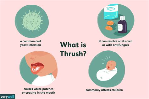 Oral Candidiasis Oral Thrush Causes Pathophysiology Signs | Hot Sex Picture