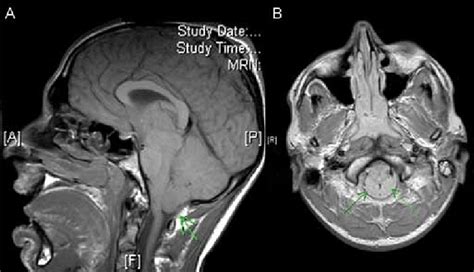 MRI brain on day 3. Both A and B (T1) show tonsillar herniation (green ...