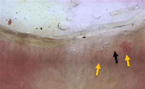 Compact subungual hyperkeratosis beneath the nail plate. | Download ...