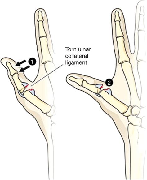 Ulnar Collateral Ligament Tear of the Thumb (Ski Pole or Gamekeeper’s Thumb) | Anesthesia Key