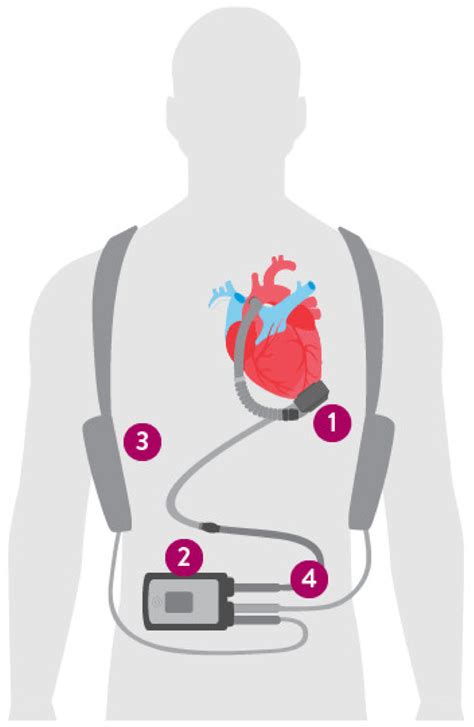 Contemporary LVAD device. Left ventricular assist device (LVAD) with... | Download Scientific ...