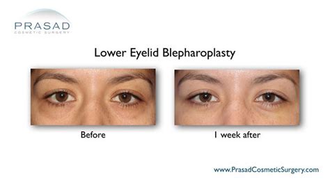 Eye Bag Surgery with Fast Recovery - New York City and Garden City, NY