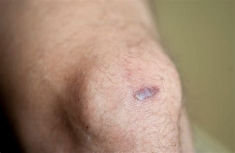 What Are Keloid Scars? | Keloid.com