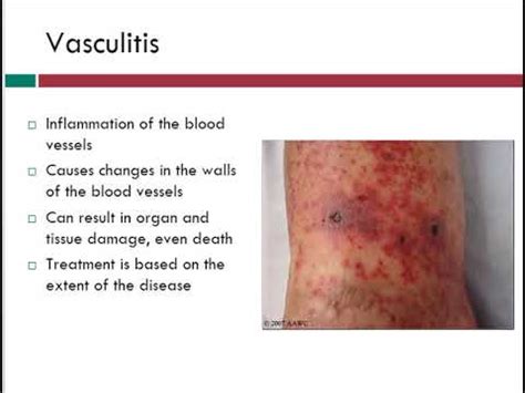 Vasculitis | Info About Vein Problems | WoundEducators.com - YouTube