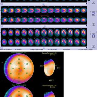 Myocardial perfusion SPECT (Single Photon Emission Computed Tomography)... | Download Scientific ...