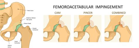 Hip impingement syndrome - Knee, Hip and Shoulder