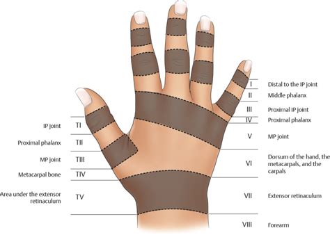 Zones of Extensor Tendon Injuries | Plastic Surgery Key