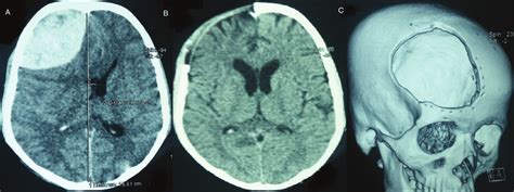 CT scan images showing (A) large right frontal extradural hematoma with ...