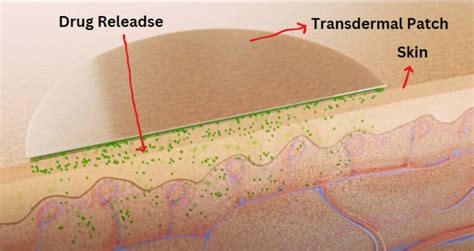 Transdermal Patches: Working, advantages, applications, and types ...