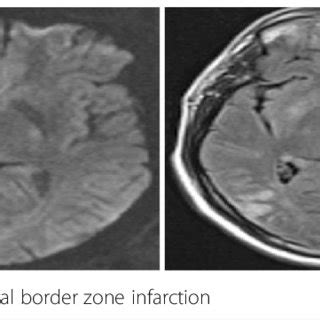 Typical examples of Fazekas grade 1, 2 and 3 white matter... | Download ...