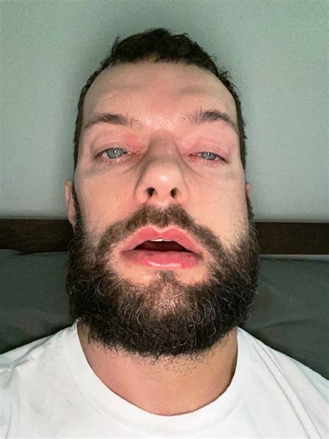 Finn Bálor Shares Post-Surgery Photo – WEB IS JERICHO