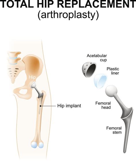 Types of total hip replacement | doctorvisit