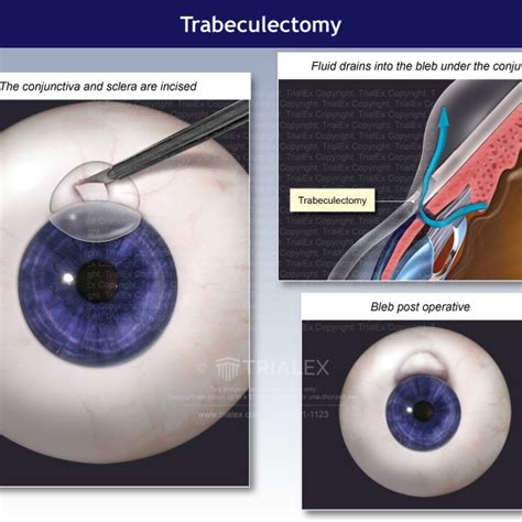 Medical Legal Exhibits - Legal Animations & Trial Graphics - Tria...