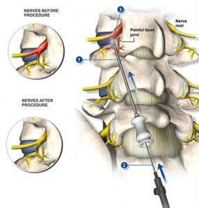 Nerve Block Injections in NYC | Pain Doctors in NY