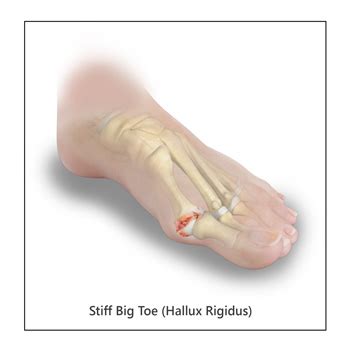 Hallux Rigidus | Seacoast Orthopedics & Sports Medicine, Newburyport, MA