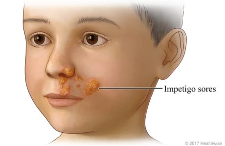 Impetigo | Cigna