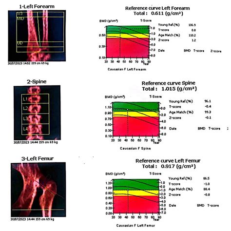 A DEXA scan was assessing the patient's bone density. The results ...