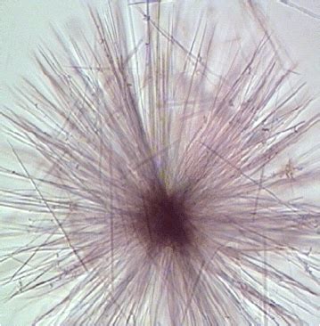 Tyrosine crystals In Urine | Medical Laboratories