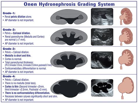 Hydronephrosis Grading Ultrasound