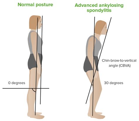 Ankylosing Spondylitis | Concise Medical Knowledge